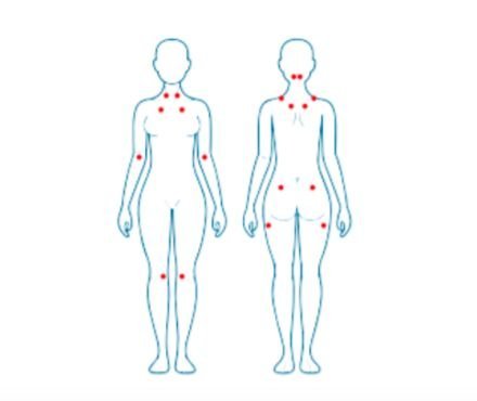Qué es la fibromialgia